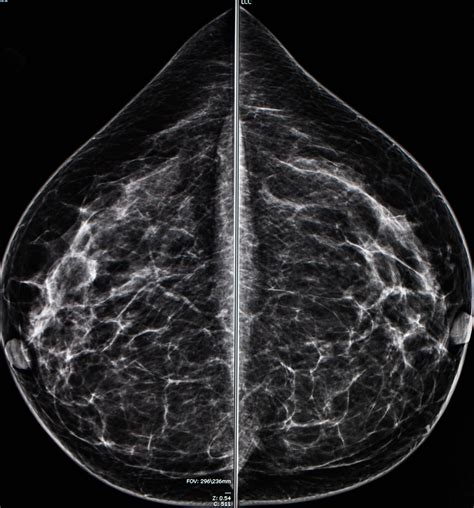 mammography compression test scale|mammogram images showing breast cancer.